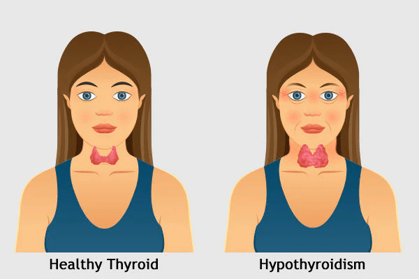 thyroid affect